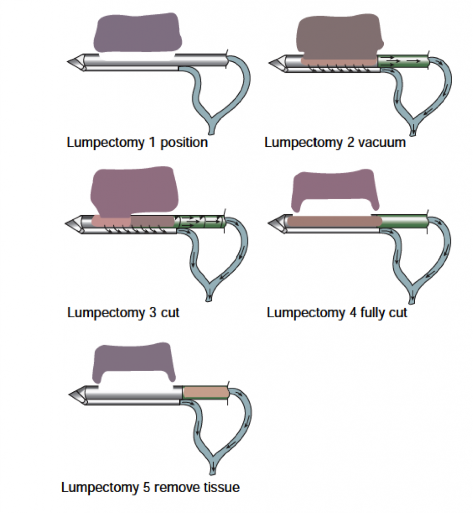 VAB (stereotactic-guided vacuum-assisted biopsy) | Centro Patología de ...